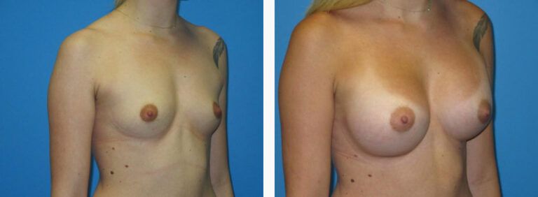 Breast Augmentation before and after treatment