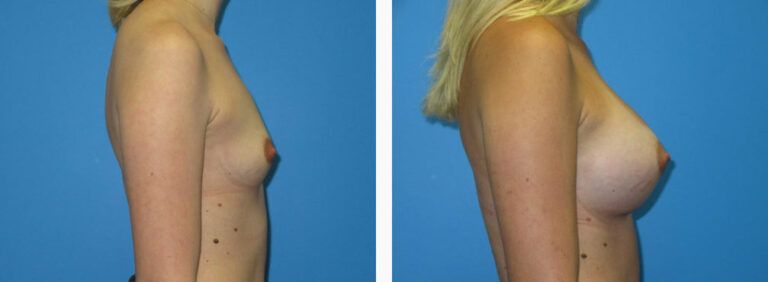 Breast Augmentation before and after treatment