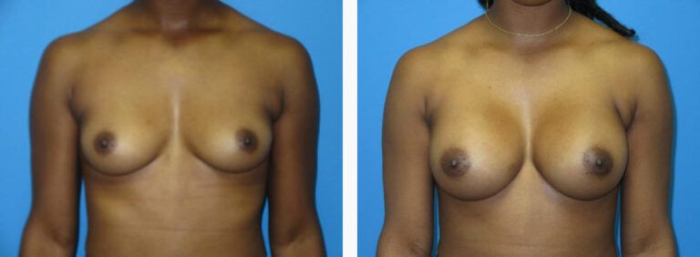 Breast Augmentation before and after treatment