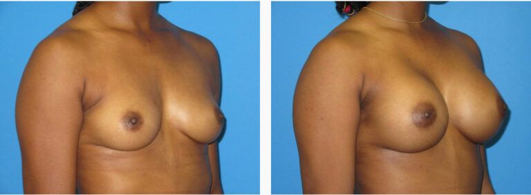Breast Augmentation before and after treatment