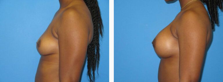 Breast Augmentation before and after treatment