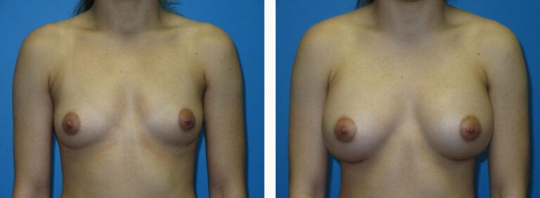 Breast Augmentation before and after treatment