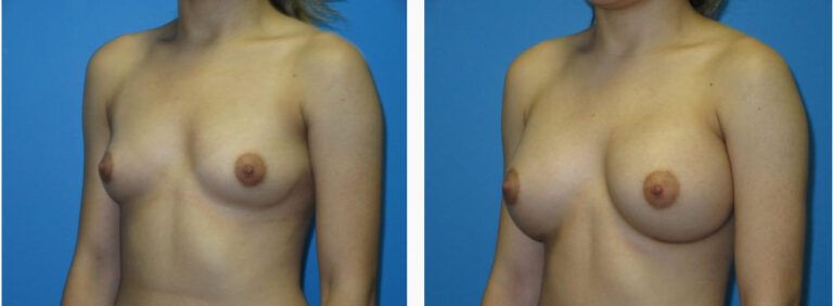 Breast Augmentation before and after treatment