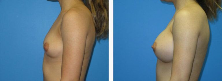 Breast Augmentation before and after treatment