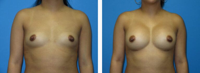 Breast Augmentation before and after treatment