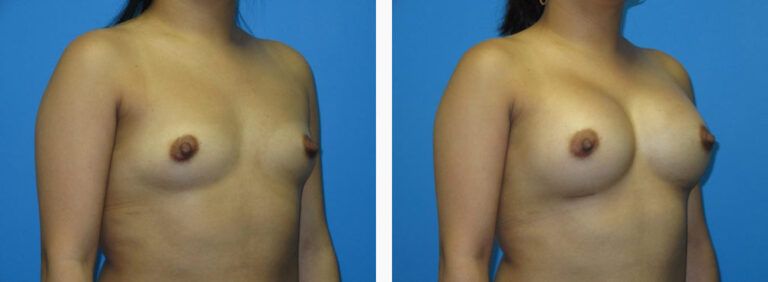 Breast Augmentation before and after treatment