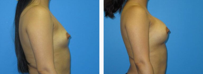Breast Augmentation before and after treatment