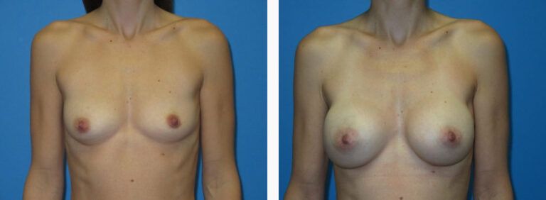 Breast Augmentation before and after treatment