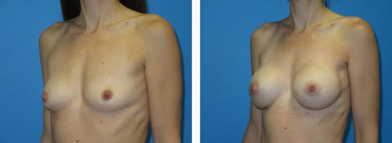 Breast Augmentation before and after treatment