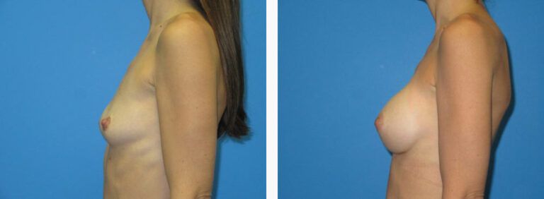 Breast Augmentation before and after treatment