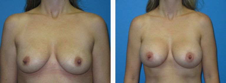 Breast Augmentation before and after treatment