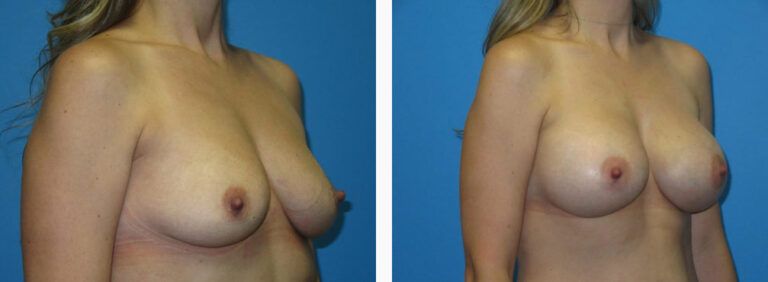 Breast Augmentation before and after treatment