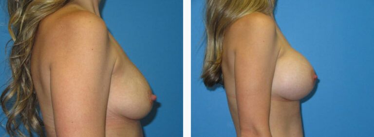 Breast Augmentation before and after treatment