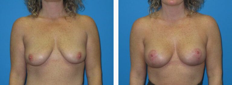 Breast Augmentation before and after treatment
