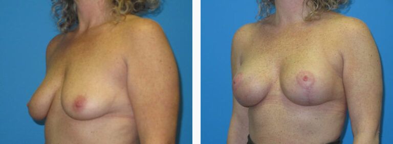 Breast Augmentation before and after treatment