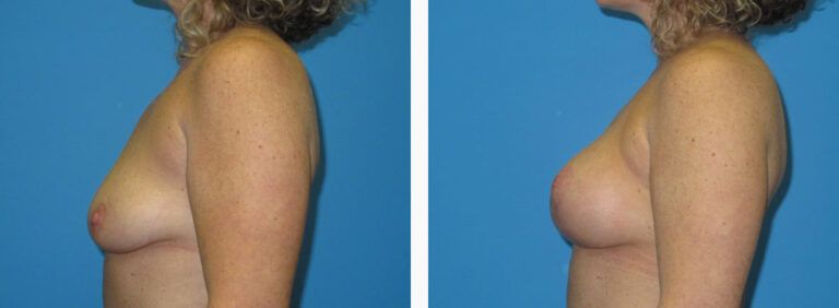 Breast Augmentation before and after treatment