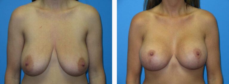 Breast Augmentation before and after treatment