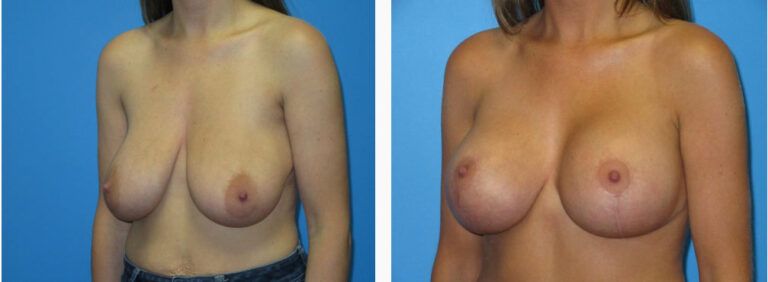 Breast Augmentation before and after treatment
