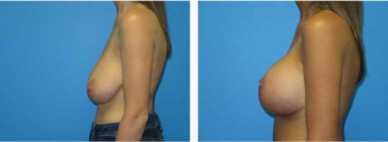 Breast Augmentation before and after treatment