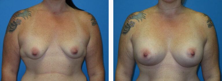 Breast Augmentation before and after treatment