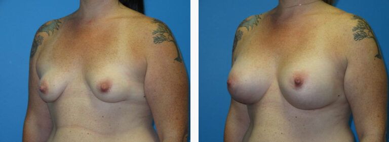Breast Augmentation before and after treatment