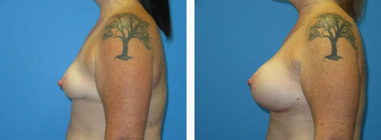 Breast Augmentation before and after treatment