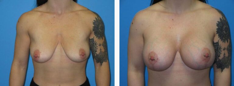 Breast Augmentation before and after treatment