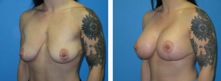 Breast Augmentation before and after treatment