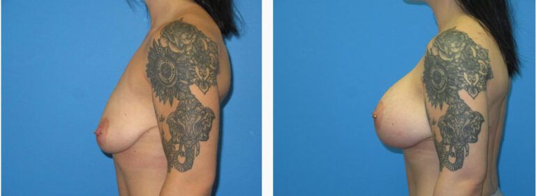 Breast Augmentation before and after treatment