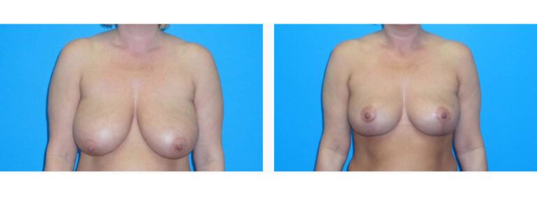 Breast Lift before and after treatment
