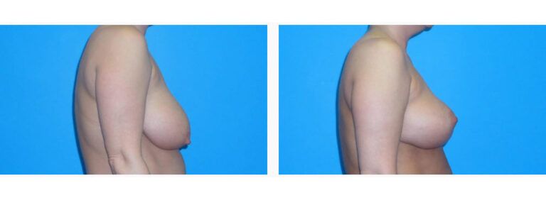 Breast Lift before and after treatment
