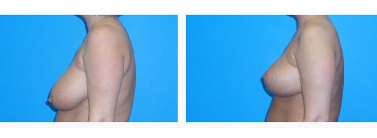 Breast Lift before and after treatment