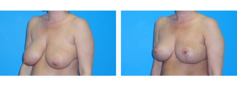 Breast Lift before and after treatment