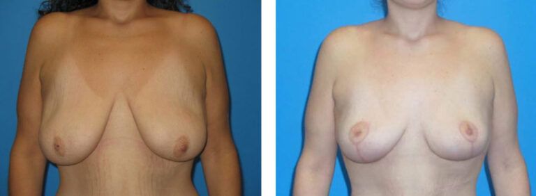 Breast Lift before and after treatment