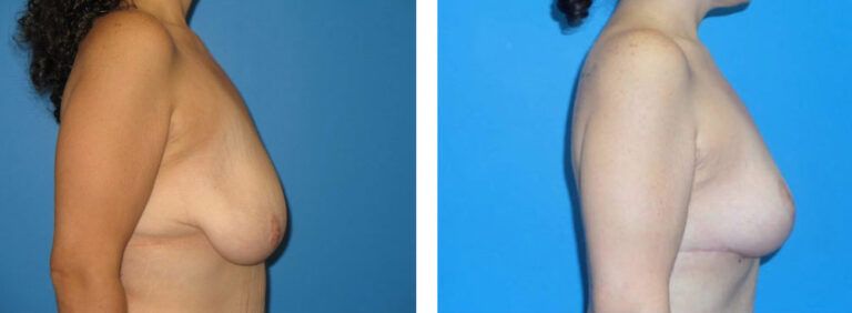 Breast Lift before and after treatment