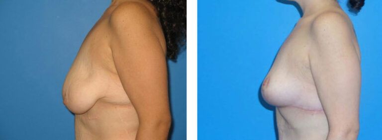 Breast Lift before and after treatment