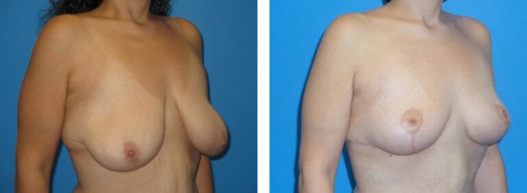 Breast Lift before and after treatment
