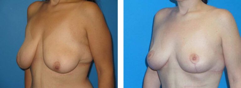 Breast Lift before and after treatment
