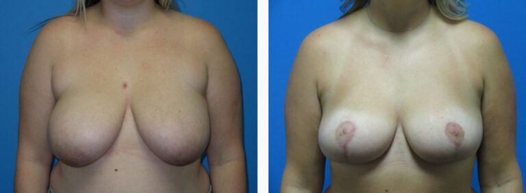 Breast Lift before and after treatment