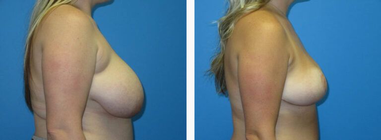 Breast Lift before and after treatment