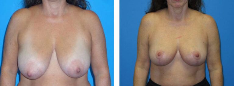Breast Lift before and after treatment