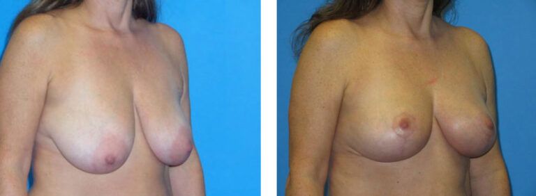 Breast Lift before and after treatment