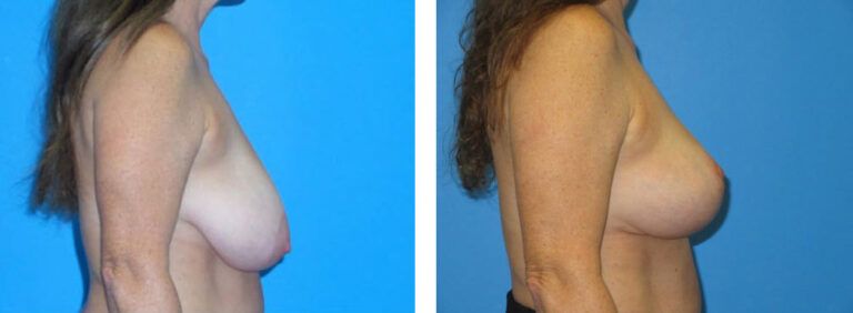 Breast Lift before and after treatment