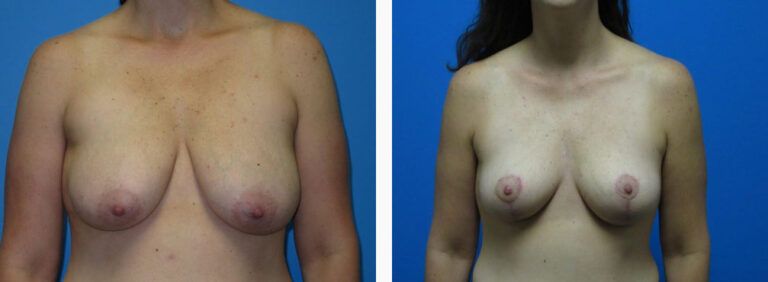 Breast Lift before and after treatment