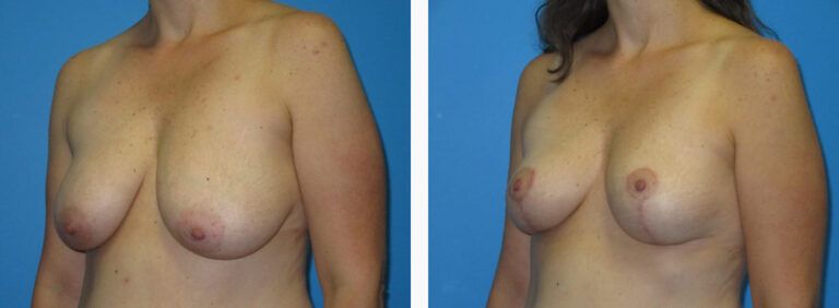 Breast Lift before and after treatment