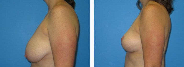 Breast Lift before and after treatment