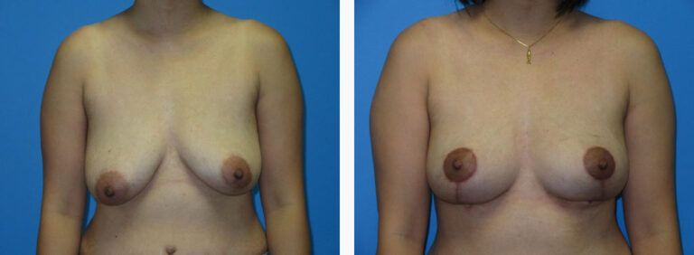 Breast Lift before and after treatment