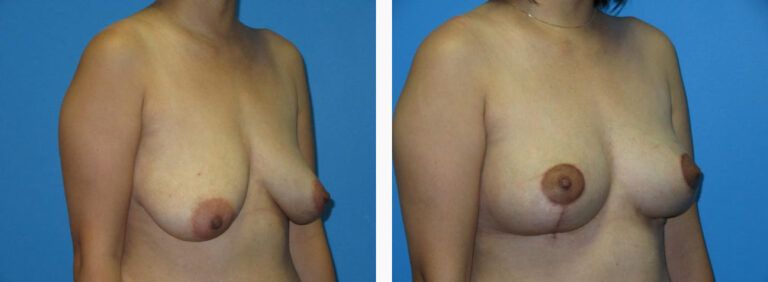 Breast Lift before and after treatment