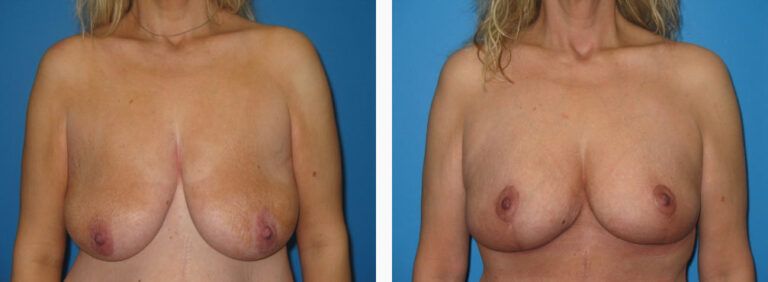 Breast Lift before and after treatment