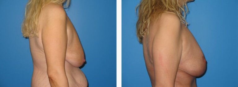 Breast Lift before and after treatment